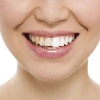 501 NAILS & SPA - teeth whitening